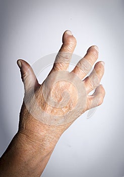 Hand Deformed From Rheumatoid Arthritis