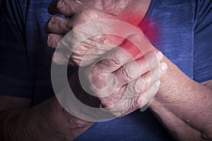 Hand Deformed From Rheumatoid Arthritis photo