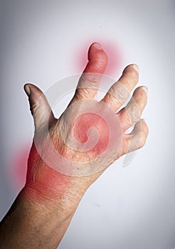 Hand Deformed From Rheumatoid Arthritis photo