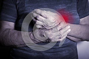 Hand Deformed From Rheumatoid Arthritis photo