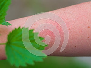 Hand with dermatitis red itchy swollen skin after touching nettle leaves sharp hairs. Plant Urtica dioica allergy