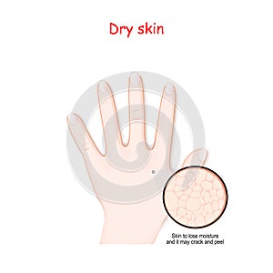 Hand with dry skin photo