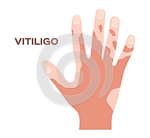 Hand and effect of vitiligo