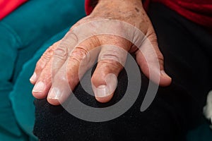 Hand of elderly person with osteoarthritis