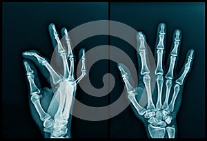 Hand and finger x-ray image