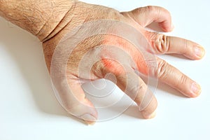 hand and fingers tendinitis ,office syndrome photo