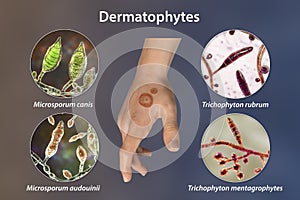 Hand fungal infection, tinea manuum, 3D illustration