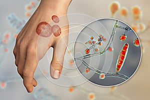 Hand fungal infection, tinea manuum, 3D illustration