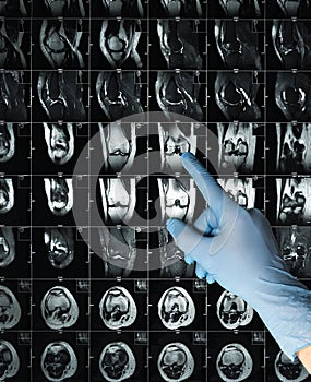 Hand in glove points Xray MRI examination magnetic resonance images showing real fracture knee