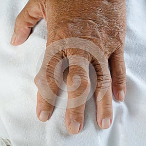 Hand of gout patient