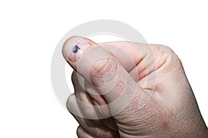 hand with a hematoma on the nail from a blow with a blunt object close-up on an isolated white background