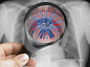Hand holding magnifying glass focusing on virus cell on lung chest xray