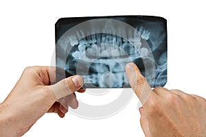 Hand holds radiograph