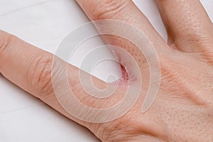 Hand with interdigital dermatitis, dyshidrotic eczema on hand close up