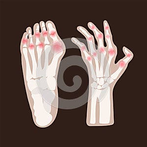 HAND LEG ARTRITIS Rheumatoid Medicine Education Vector Scheme photo