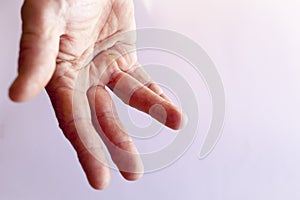 Hand of an man with Dupuytren contracture