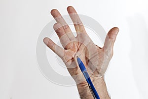 Hand of an man with Dupuytren contracture