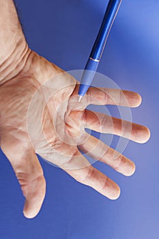 Hand of an man with Dupuytren contracture on blue