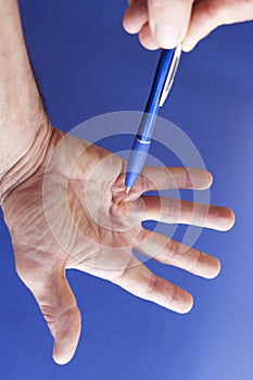 Hand of an man with Dupuytren contracture on blue