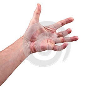 Hand of an man with Dupuytren contracture disease