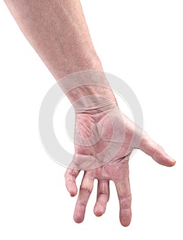 Hand of an man with Dupuytren contracture disease