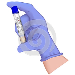 Hand in medical glove with tube test Coronavirus 2019-nCoV swab Sample. Positive blood test result for Covid 19 virus Corona virus