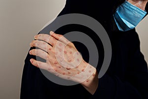 Hand with monkeypox rash on shoulder photo