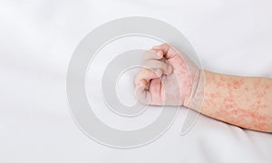 Hand of newborn baby with measles rash on white sheet