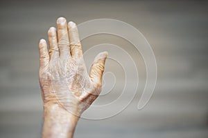 The hand of old man with the wrinkled hand and bruised from the body lack of nutrition protein.