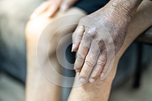 The hand of old man with the wrinkled hand and bruised from the body lack of nutrition protein.