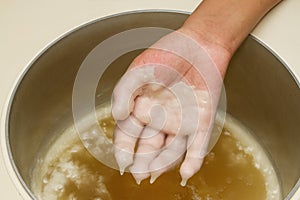 Hand in paraffin bath