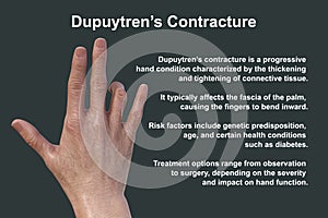 Hand of a patient with Dupuytren's contracture, photorealistic 3D illustration photo