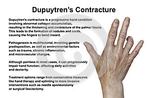 Hand of a patient with Dupuytren's contracture, photorealistic 3D illustration photo