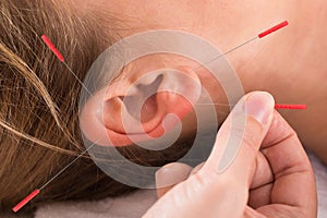 Hand Performing Acupuncture Therapy On Auricle