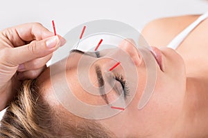 Hand Performing Acupuncture Therapy On Head