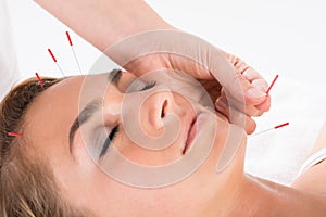 Hand Performing Acupuncture Therapy On Head