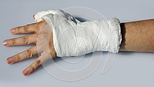 Hand with plaster to immobilize the wrist and the thumb