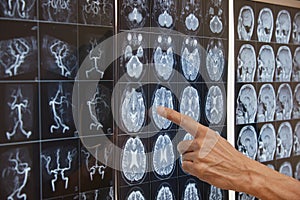 A hand pointing at brain MRI on the light box