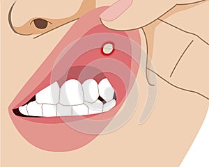 Hand-pull upper lip with aphthae or aphtha close up, illustration cartoon photo