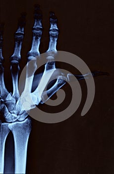 Hand radiography photo
