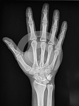 Hand radiography