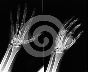 Hand X-Ray