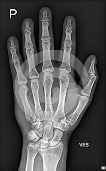 Hand X-Ray