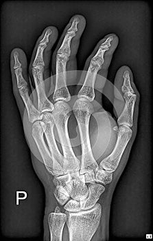 Hand X-Ray