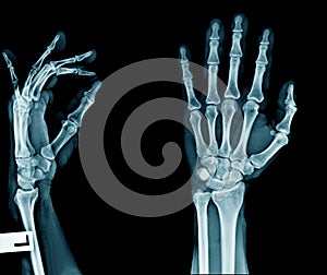 Hand x-ray on black background