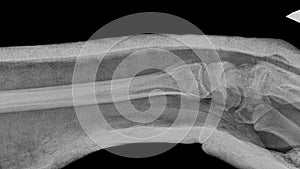 Hand X-ray after bone repositioning. Picture of a broken arm in plaster after a trauma surgeon`s procedure