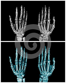 Hand x-ray collection