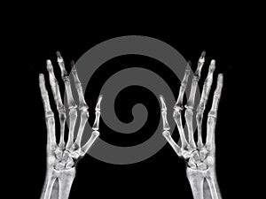 Hand x-ray film from hospital broken bone