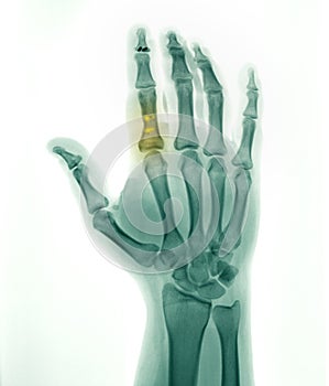 Hand X-ray, flexor tendon repair