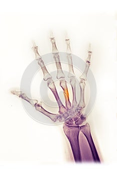 Hand x-ray, fractured metacarpal